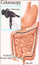 Colonoscopy procedure.