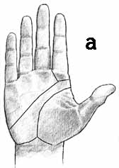 Dermatoglyphics: ordinary axial triradius and ordinary a-line