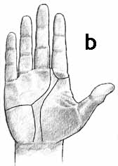 Dermatoglyphics: high positioned axial triradius + a-line