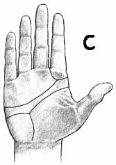 Dermatoglyphics: slightly high positioned axial triradius + slightly high a-line