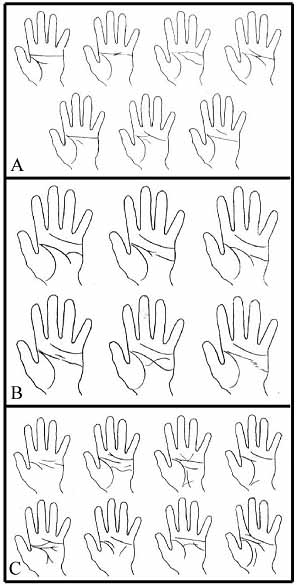 Abnormal hand lines.