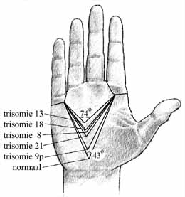 AtD-angle in trisomy disorders