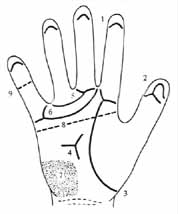 Dermatoglyphics in Edward syndrome