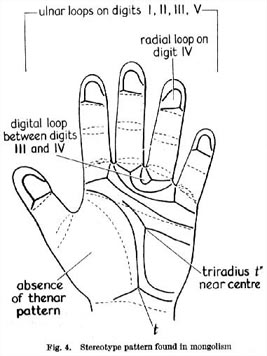 Phantom picture for the hand in Down syndrome (trisomy 21).