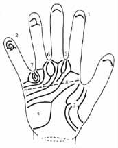 Phantom picture for the hand in Warkany syndrome (trisomy 8): dermatoglyphics + major palmar lines.