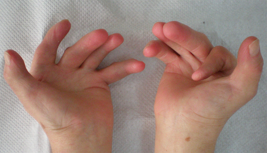 Arthrogryposis hands.