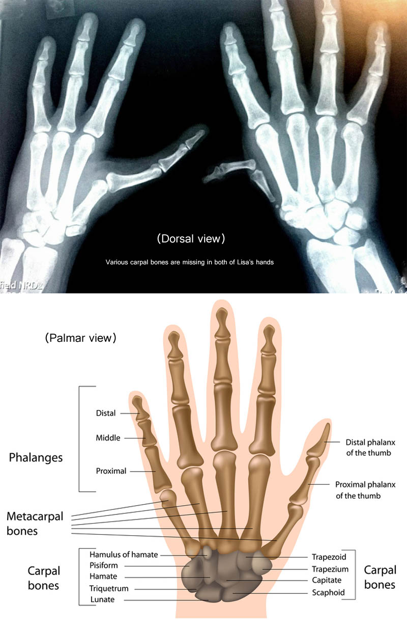 Carpal bones anomaly in Holt-Oram syndrome, featured with thumb hypoplasia.