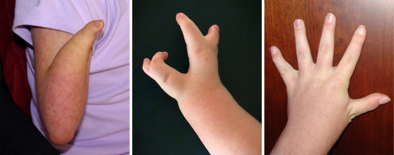Range of hand abnormalities in Cornelia de Lange syndrome.