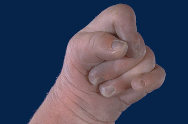 Clenched hand with overlapping fingers in Edwards syndrome.