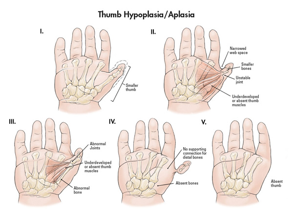 Five stages of thumb hypoplasia/aplasia.