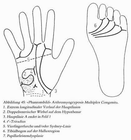 Phantom picture for the hand in arthrogryposos: dermatoglyphics + major palmar lines.