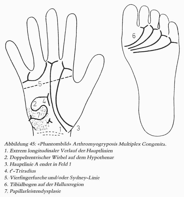 Hand chart for arthrogryposis (1981)