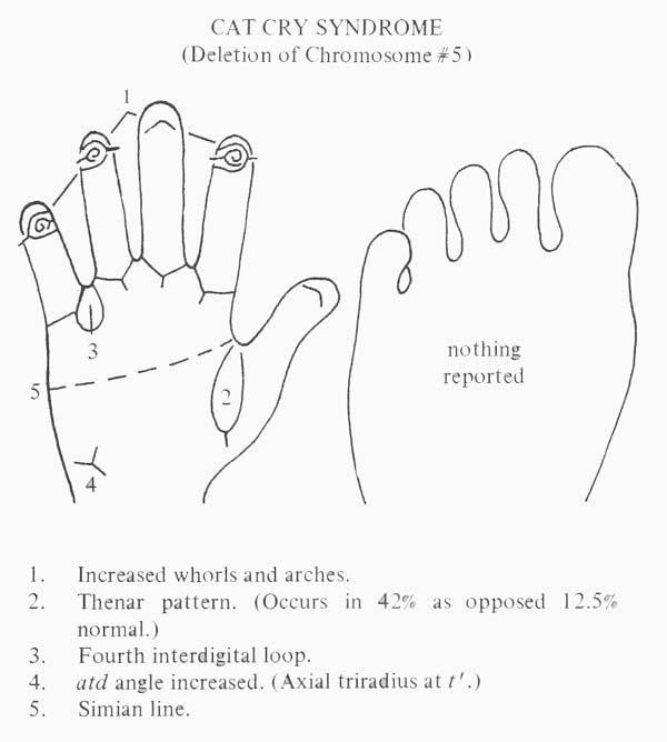 Hand chart for Cat cry syndrome - Handbook of Clinical Dermatoglyphs (1971).