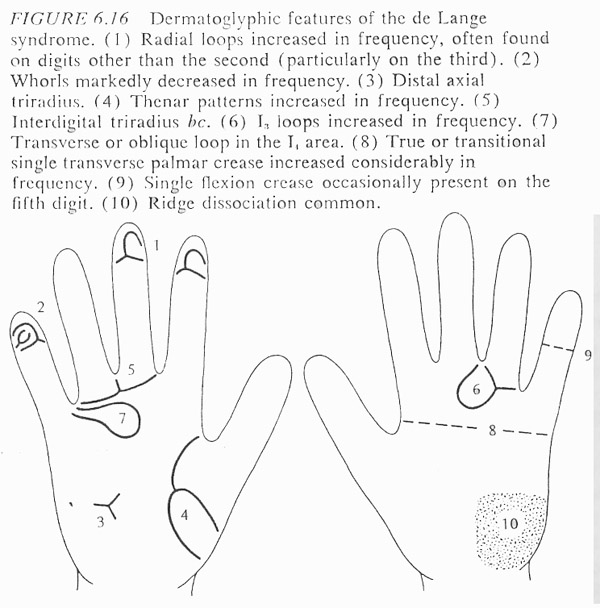 Hand chart for Cornelia de Lange syndrome - Dermatoglyphics in Medical Disorders (1976).