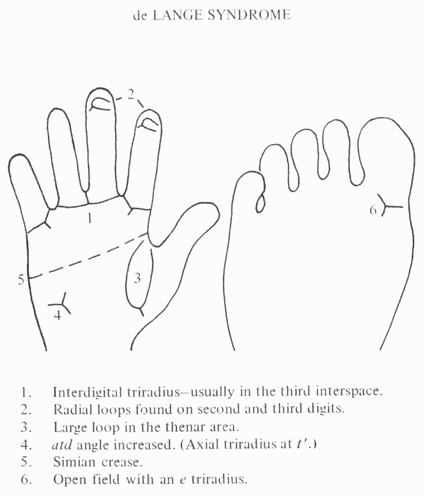 Hand chart for Cornelia de Lange syndrome - Handbook of Clinical Dermatoglyphics (1971).