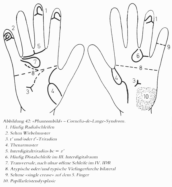 Hand chart for Cornelia de Lange syndrome (A. Rodewald & H. Zankl, 1981)