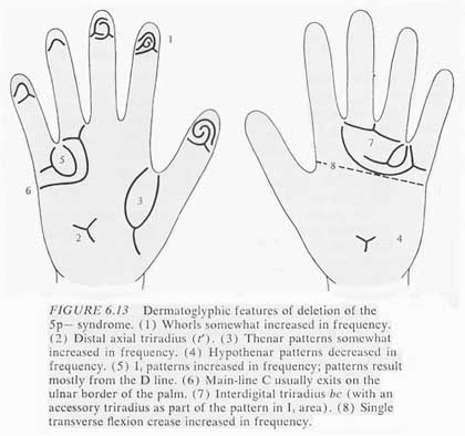 Phantom picture for the hand in cri-du-chat syndrome: dermatoglyphics + major palmar lines.