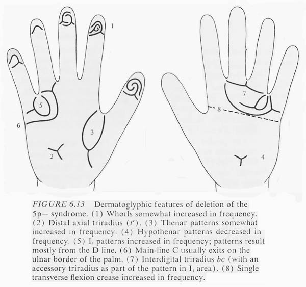 Hand chart for cri-du-chat syndrome - Dermatoglyphics in Medical Disorders (1976).