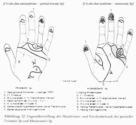 Phantom picture for the hand in trisomy 5 syndrome & cri-du-chat syndrome: dermatoglyphics + major palmar lines.