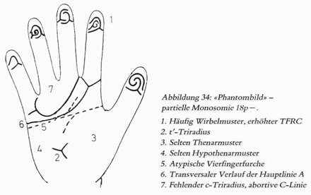 Phantom picture for the hand in de Grouchy syndrome 1 (18p deletion syndrome): dermatoglyphics + major palmar lines.