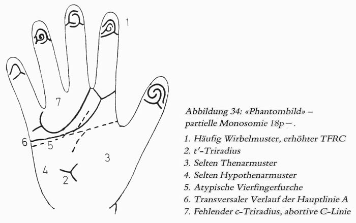 Hand chart for de Grouchy syndrome 1 - Hautleistenfibel (1981).