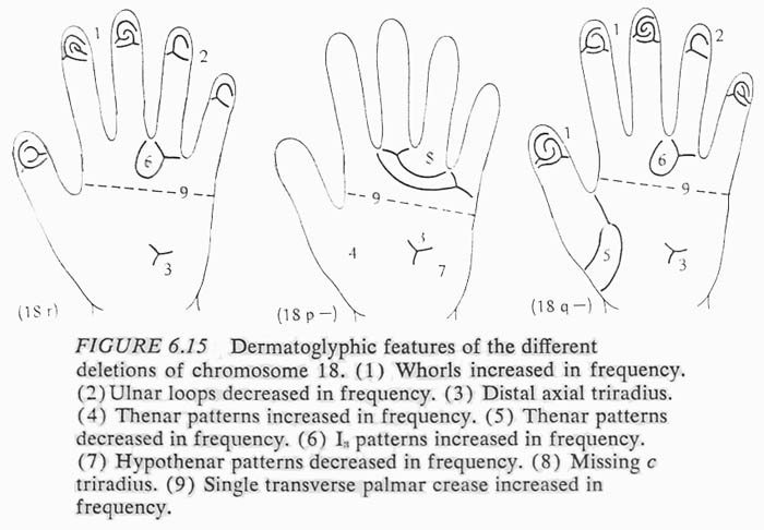 Typical hand characteristics in de Grouchy syndrome.