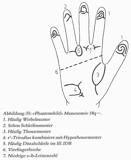 Phantom picture for the hand in de Grouchy syndrome 2 (18q deletion syndrome): dermatoglyphics + major palmar lines