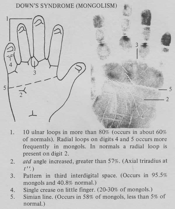 Hand chart for Down syndrome - Handbook of Clinical Dermatoglyphics (1971).