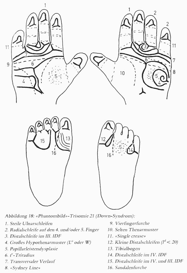 Hand chart for Down syndrome - Hautleistenfibel (1981).