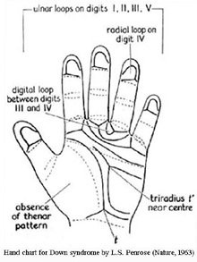 Hand chart for Down syndrome by L.S. Penrose (1963).