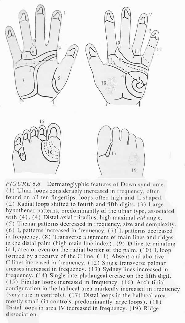 Hand chart for Down syndrome - Dermatoglyphics in Medical Disorders (1976).