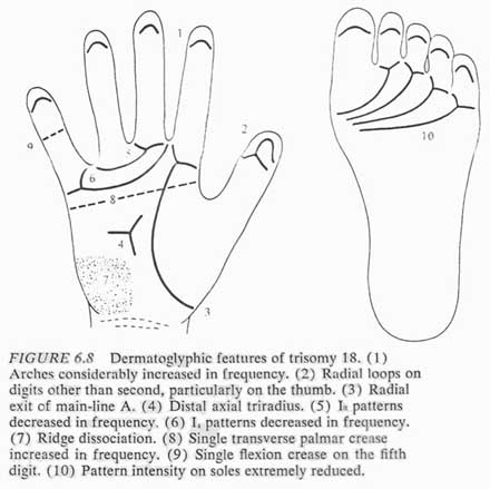 Phantom picture for the hand in Edwards syndrome (trisomy 18): dermatoglyphics + major palmar lines.