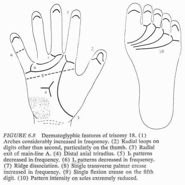 Typical hand characteristics in Edwards syndrome.