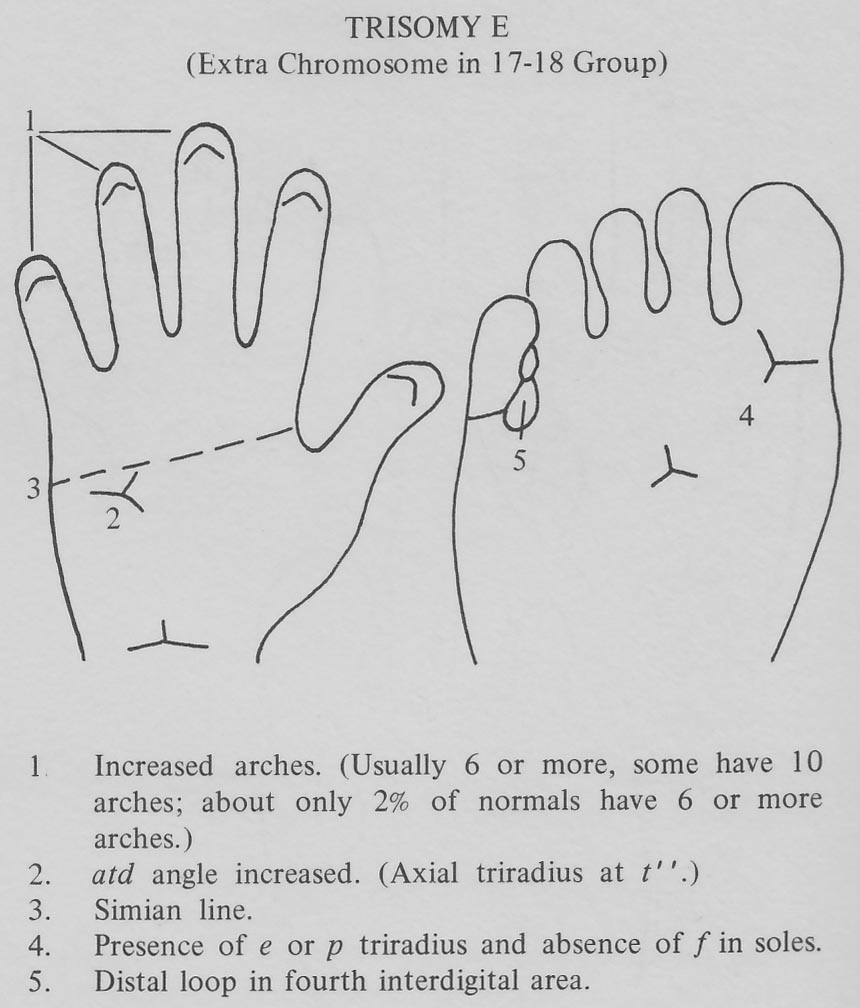 Hand chart for Edwards syndrome - Handbook of Clinical Dermatoglyphics (1971).