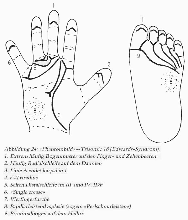 Hand chart for Edwards syndrome (1981)