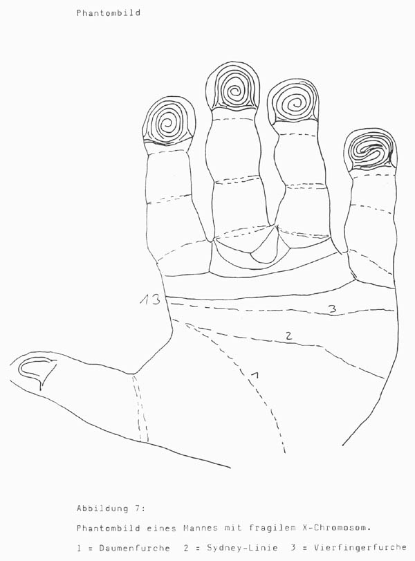 Hand chart for fragile-X syndrome (1985).