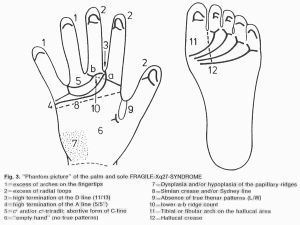 Hand chart for fragile-X syndrome (1986).