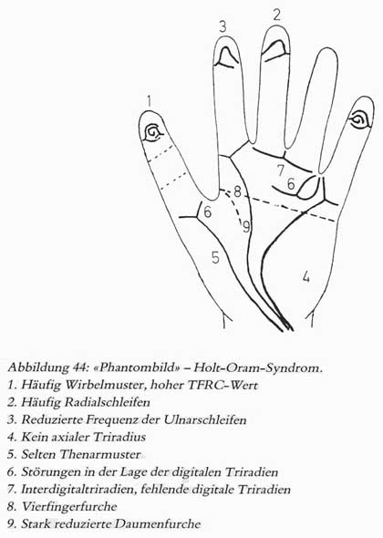 Phantom picture for the hand in Holt-Oram syndrome.