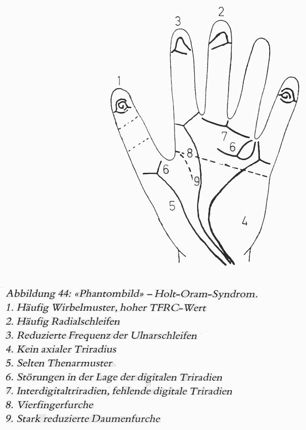 Hand chart for Holt-Oram syndrome - Hautleistenfibel (1981).