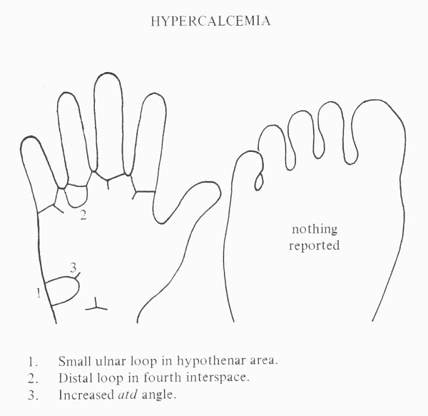 Typical hand characteristics in hypercalcemia.