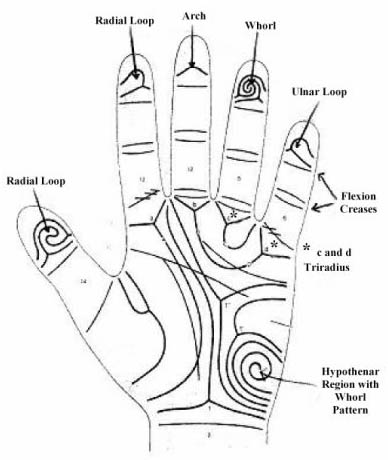 Phantom picture for the hand in Kabuki make-up syndrome: dermatoglyphics + major palmar lines.