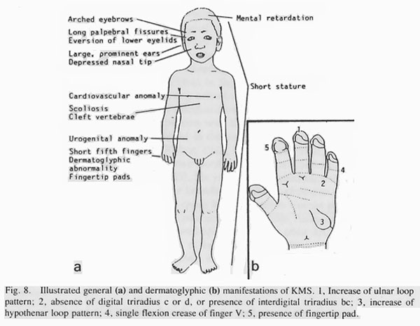 Hand chart for Kabuki syndrome by Niikawa (1988).