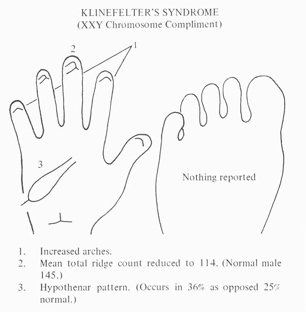 Hand chart for Klinefelter syndrome - Handbook of Clinical Dermatoglyphs (1971).