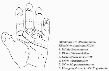 Phantom picture for the hand in Klinefelter syndrome (XXY): dermatoglyphics + major palmar lines.