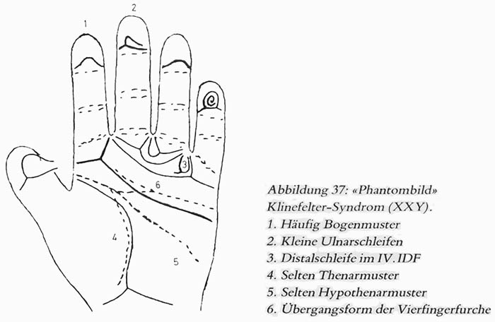 Hand chart for Klinefelter syndrome - Hautleistenfibel (1981).