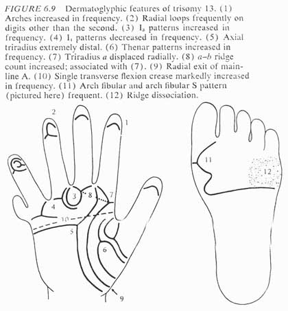 Phantom picture for the hand in Patau syndrome (trisomy 13): dermatoglyphics + major palmar lines.