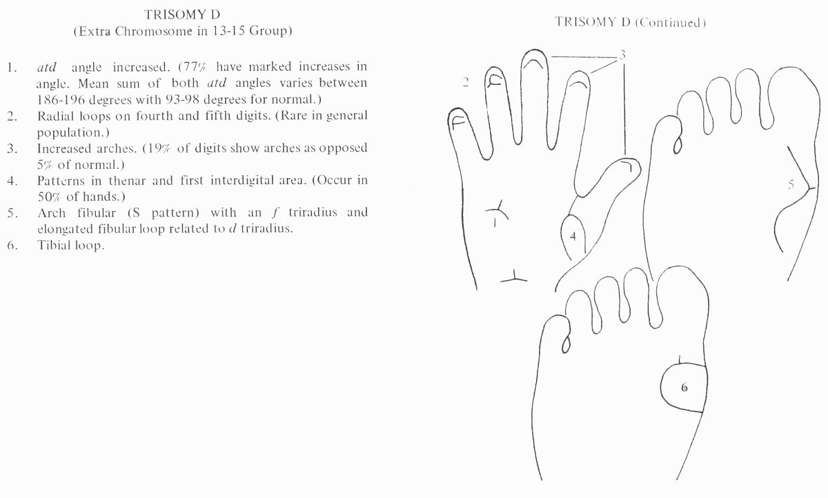 Hand chart for Patau syndrome - Handbook of Clinical Dermatoglyphics (1971).