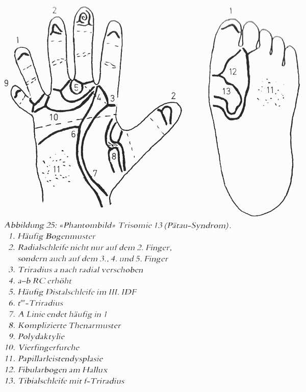 Hand chart for Patau syndrome (1981)
