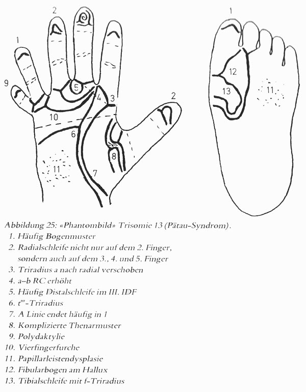 Hand chart for Patau syndrome (2013).