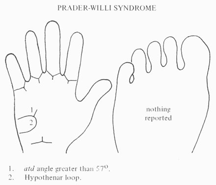 Phantom picture for the hand in Prader-Willi syndrome (15p deletion syndrome): dermatoglyphics + major palmar lines.